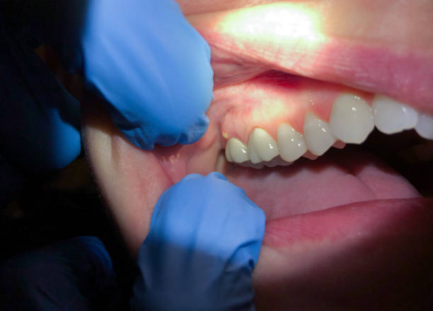 Best Emergency Wisdom Tooth Extraction in Leonard, TX